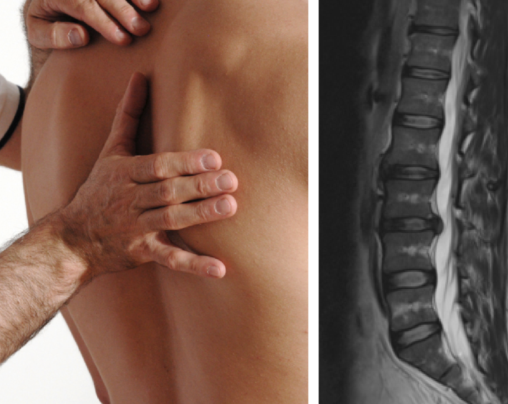 Gegenüberstellung eines Rückens während der Behandlung und eines Röntgenbildes der Wirbelsäule